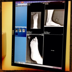 My left foot. The X-ray came out negative.